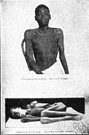 epidemic encephalitis - an encephalitis that was epidemic between 1915 and 1926