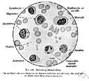 acute myelocytic leukemia - acute leukemia characterized by proliferation of granular leukocytes