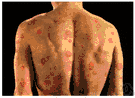 urtication - an itchy skin eruption characterized by weals with pale interiors and well-defined red margins