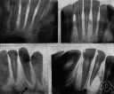 bitewing - a dental X-ray film that can be held in place by the teeth during radiography