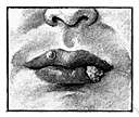 ulcerated - having an ulcer or canker