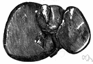 megalohepatia - abnormal enlargement of the liver