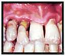 alveolar process - a ridge that forms the borders of the upper and lower jaws and contains the sockets of the teeth