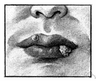 canker - an ulceration (especially of the lips or lining of the mouth)