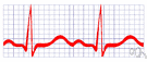 cardiogram - a graphical recording of the cardiac cycle produced by an electrocardiograph