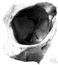 cranial orbit - the bony cavity in the skull containing the eyeball