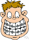 orthodontic braces - an appliance that corrects dental irregularities