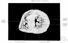 systole - the contraction of the chambers of the heart (especially the ventricles) to drive blood into the aorta and pulmonary artery