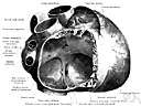 atrial - of or relating to a cavity or chamber in the body (especially one of the upper chambers of the heart)