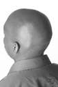 phalacrosis - the condition of having no hair on the top of the head
