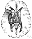 lateral ventricle - either of two horseshoe-shaped ventricles one in each cerebral hemisphere