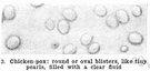 syphilis - a common venereal disease caused by the treponema pallidum spirochete