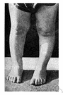 bow leg - a leg bowed outward at the knee (or below the knee)