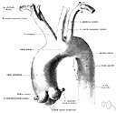 aortic aneurysm - an aneurysm of the aorta