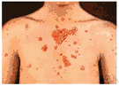 psoriasis - a chronic skin disease characterized by dry red patches covered with scales