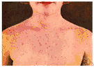 rubella - a contagious viral disease that is a milder form of measles lasting three or four days